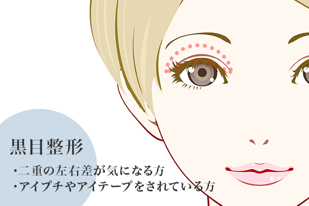 黒目整形 | 二重まぶた＋眼瞼下垂（切開なし）