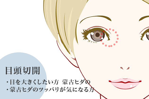目頭切開
