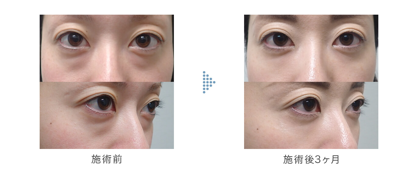 切らない下眼瞼